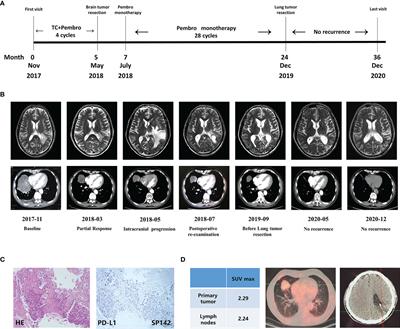 Case Report: Pathological Complete Response in a Brain-Metastatic Lung Squamous Cell Carcinoma Patient With Long-Term Benefit From Chemo-Immunotherapy